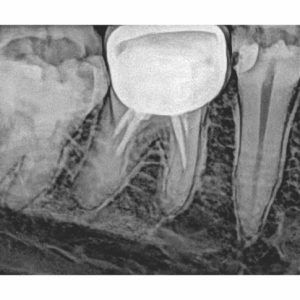 Xpect Vision Intraoral Sensor